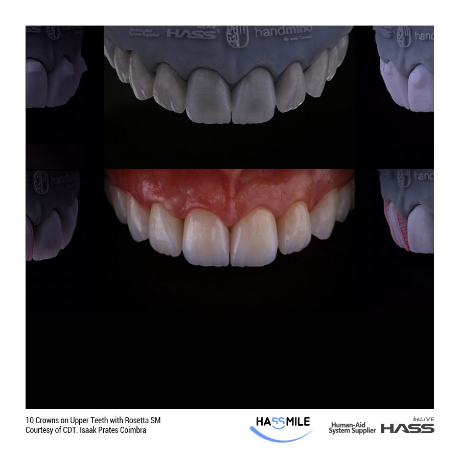 10 Crowns on Upper Teeth with Rosetta SM