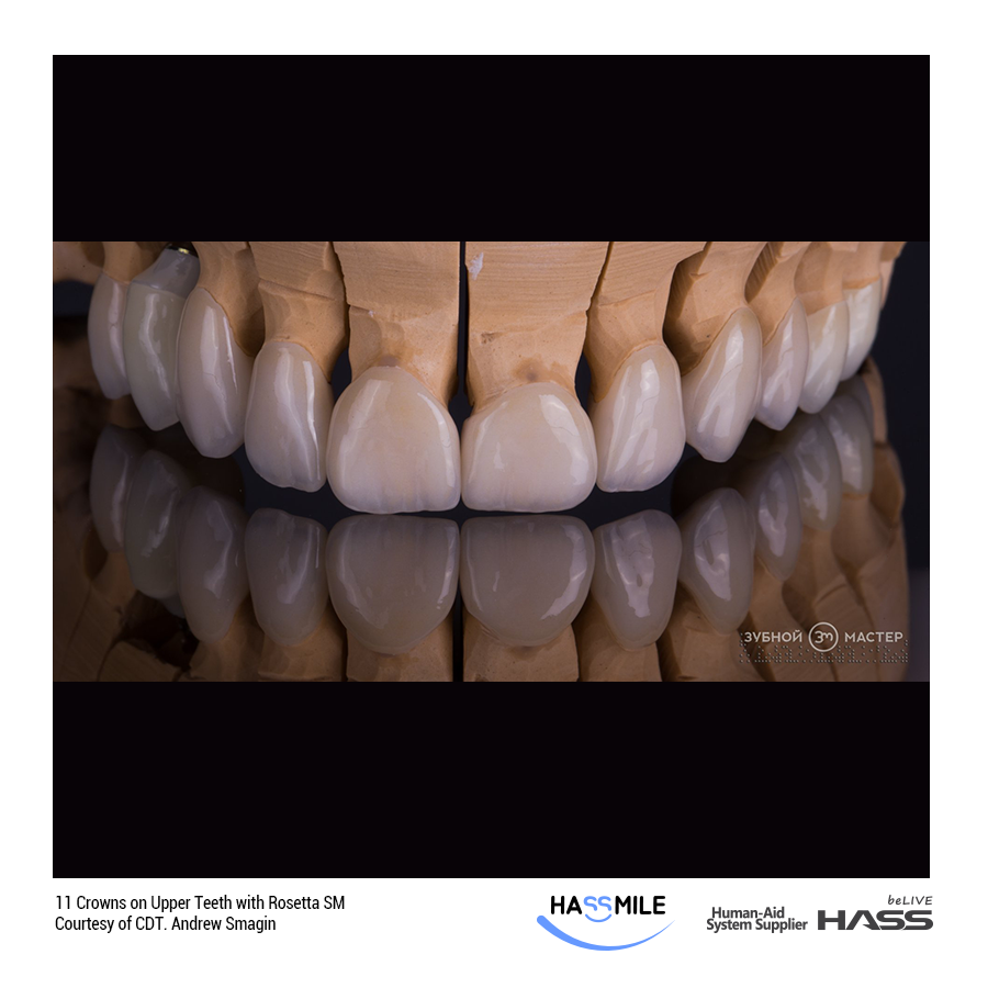 11 Crowns on Upper Teeth with Rosetta SM(LT)