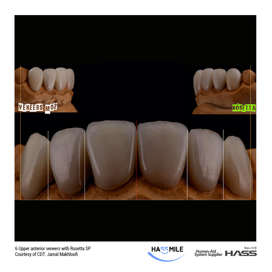 6 Upper anterior veneers with Rosetta SP