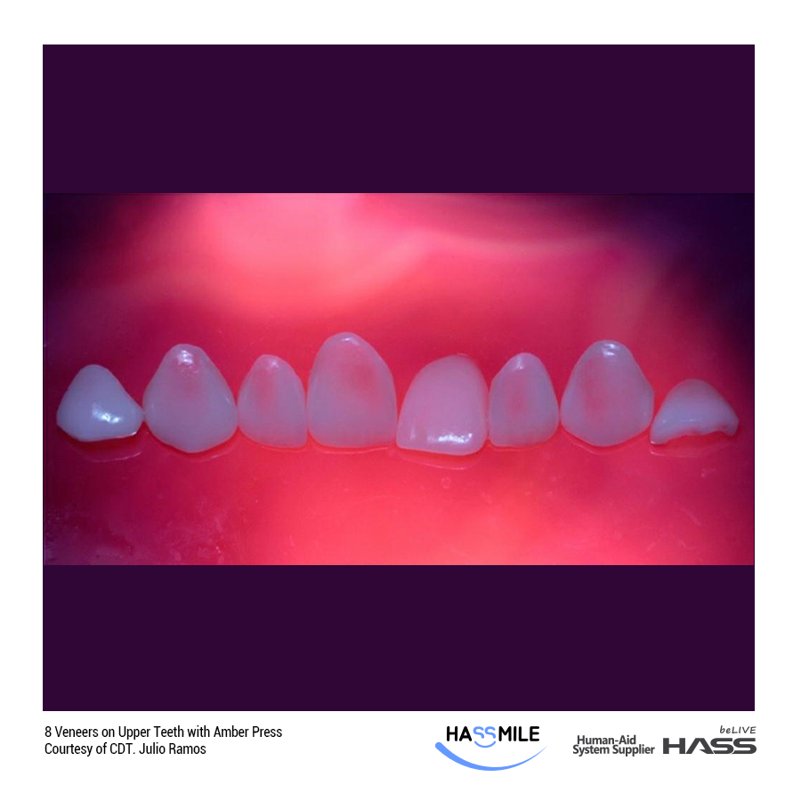 8 Veneers on Upper Teeth with Amber Press (LT)