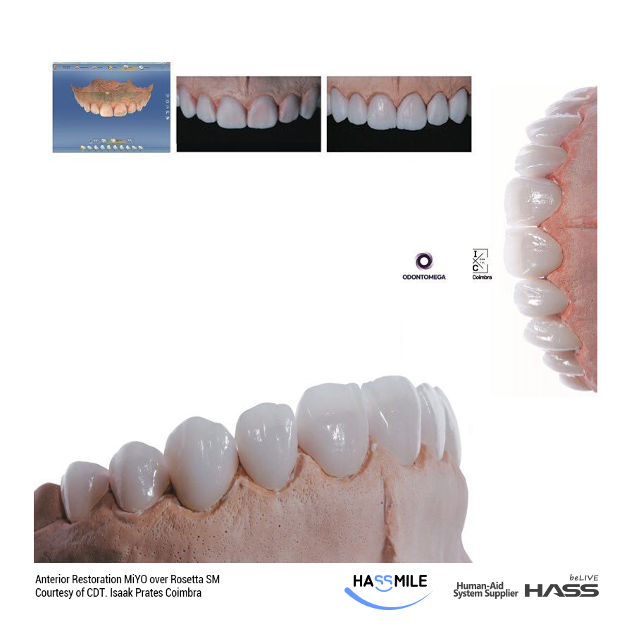 Anterior Restoration MiYO over Rosetta SM