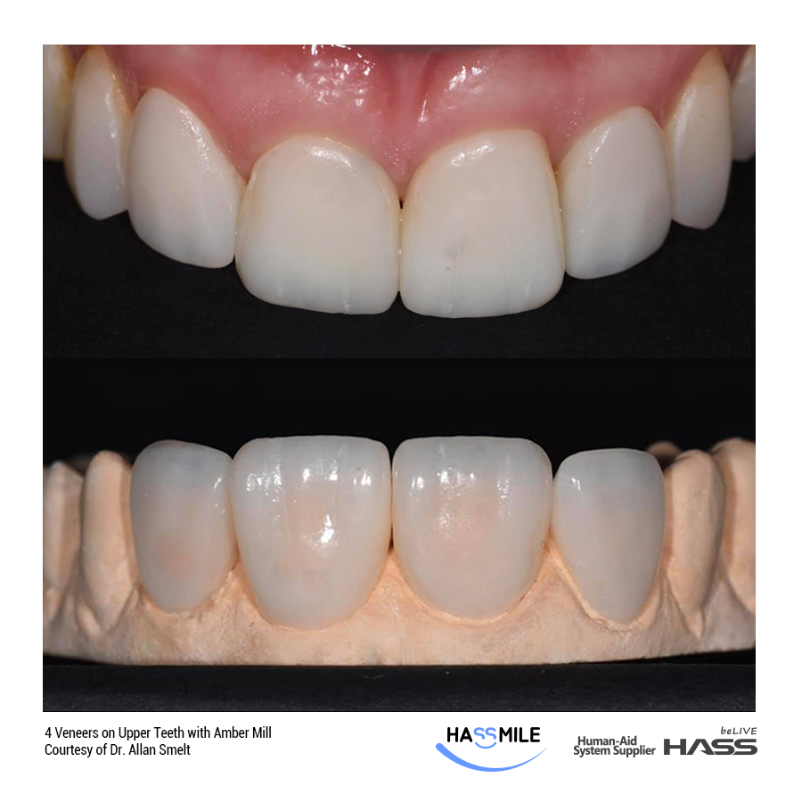 4 Veneers on Upper Teeth with Amber Mill