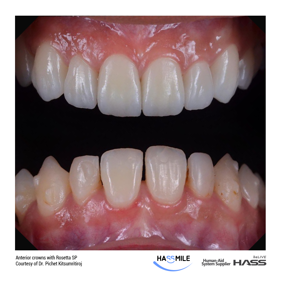 Anterior crowns with Rosetta SP