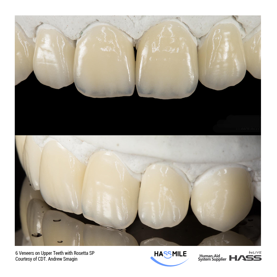 6 Veneers on Upper Teeth with Rosetta SP (LT)