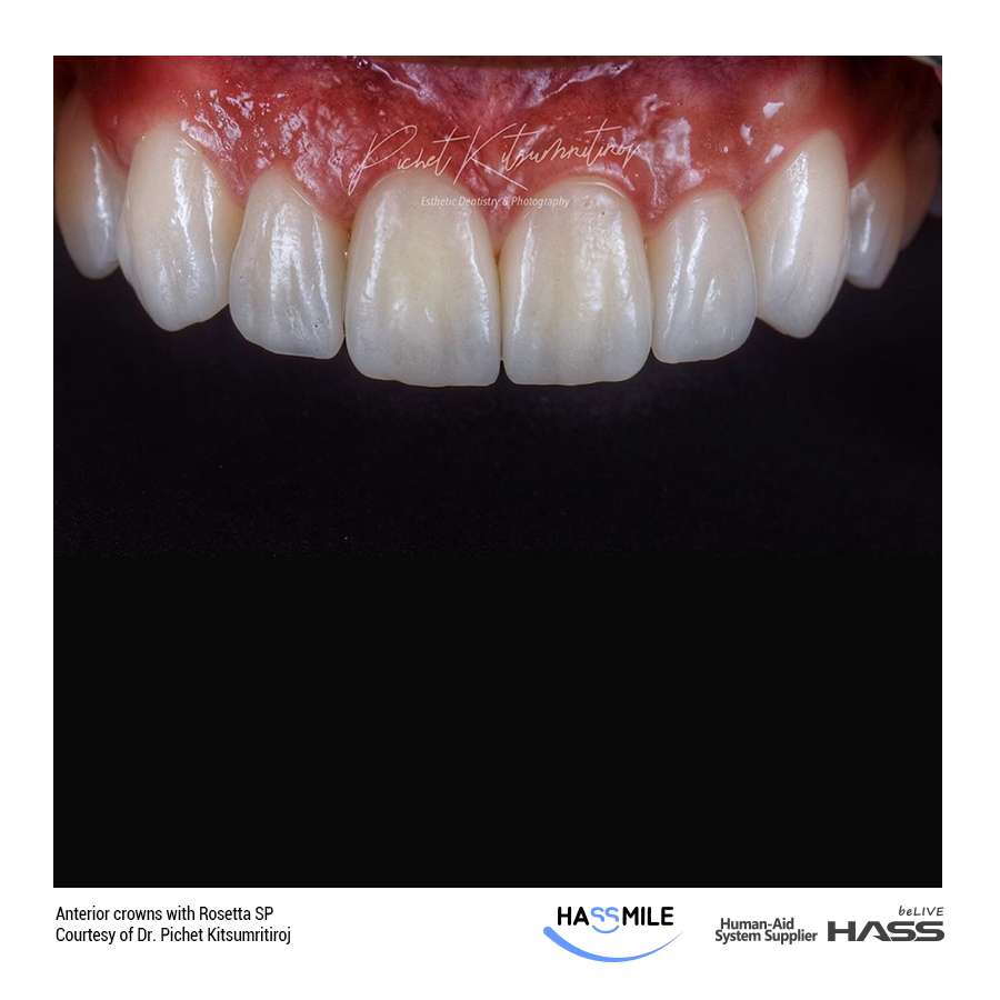 Anterior crowns with Rosetta SP