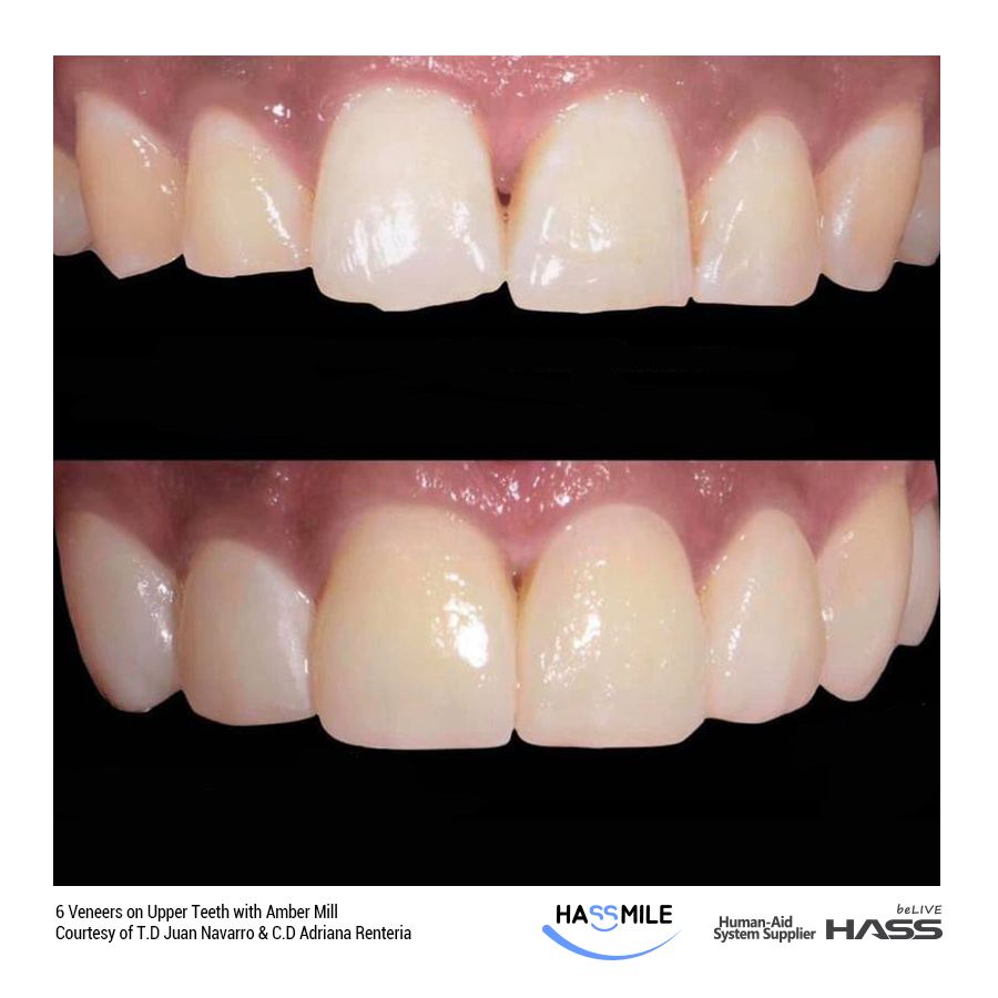 6 Veneers on Upper Teeth with Amber Mill