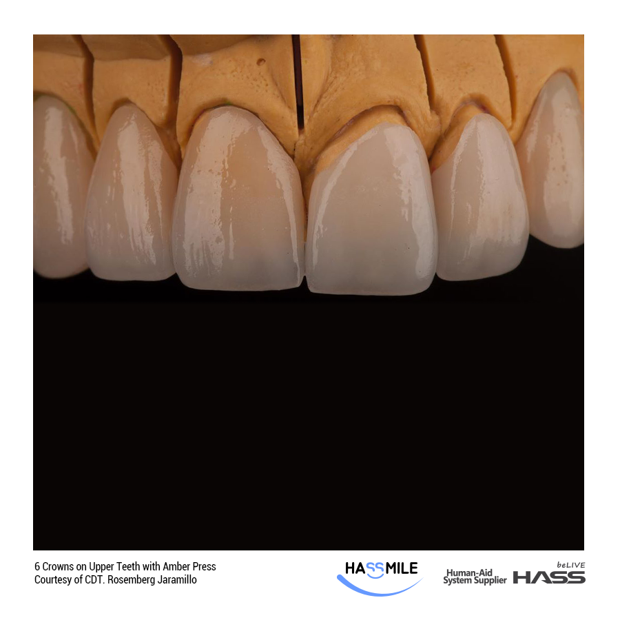 6 Crowns on Upper Teeth with Amber Press