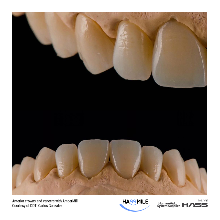 Anterior crowns and veneers with Amber Mill