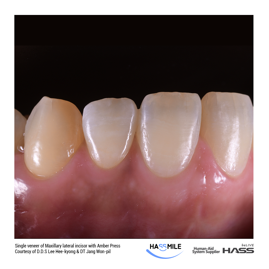 Single veneer of Maxillary lateral incisor with Amber Press