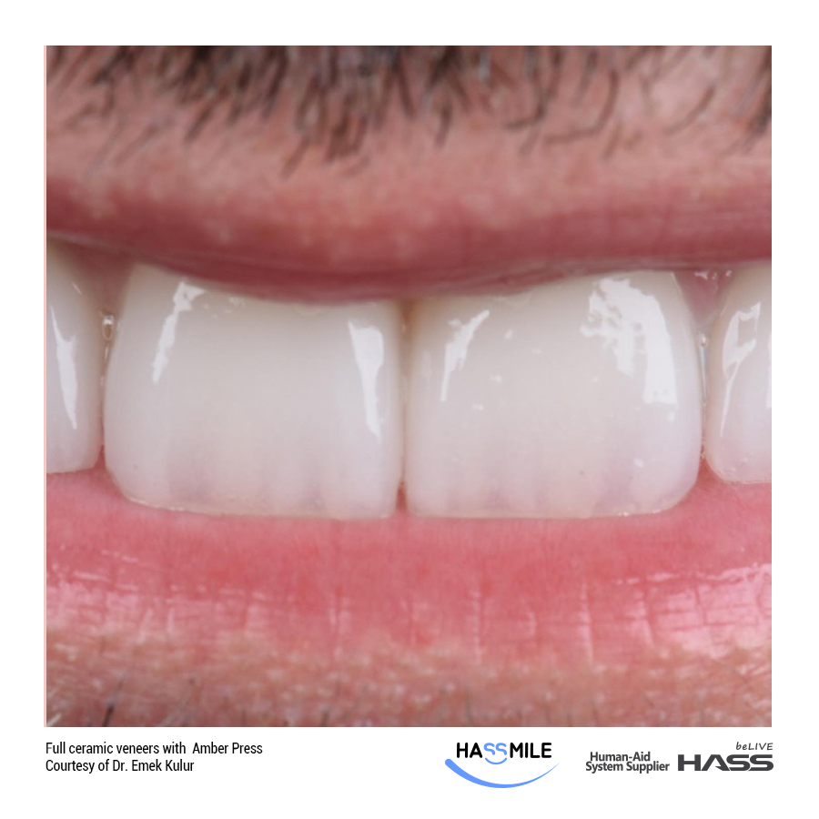 Full ceramic veneers with  Amber Press (LT)