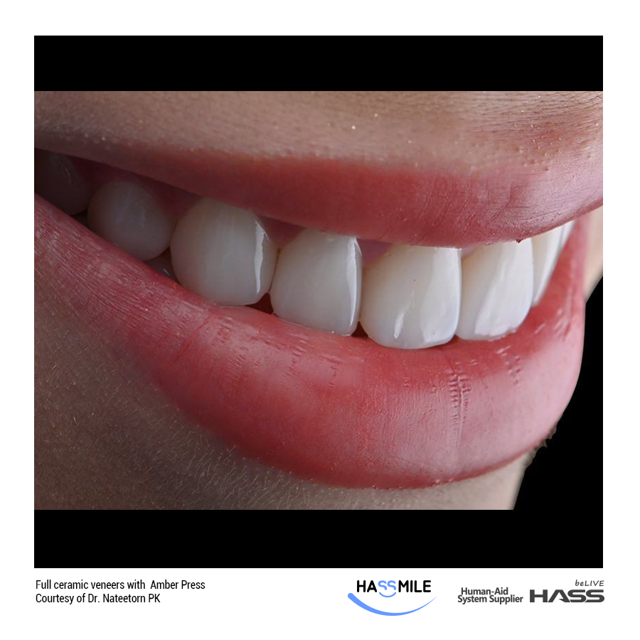 Full ceramic veneers with  Amber Press (HT)