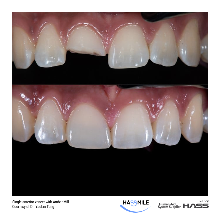 Single anterior veneer with Amber Mill (LT)