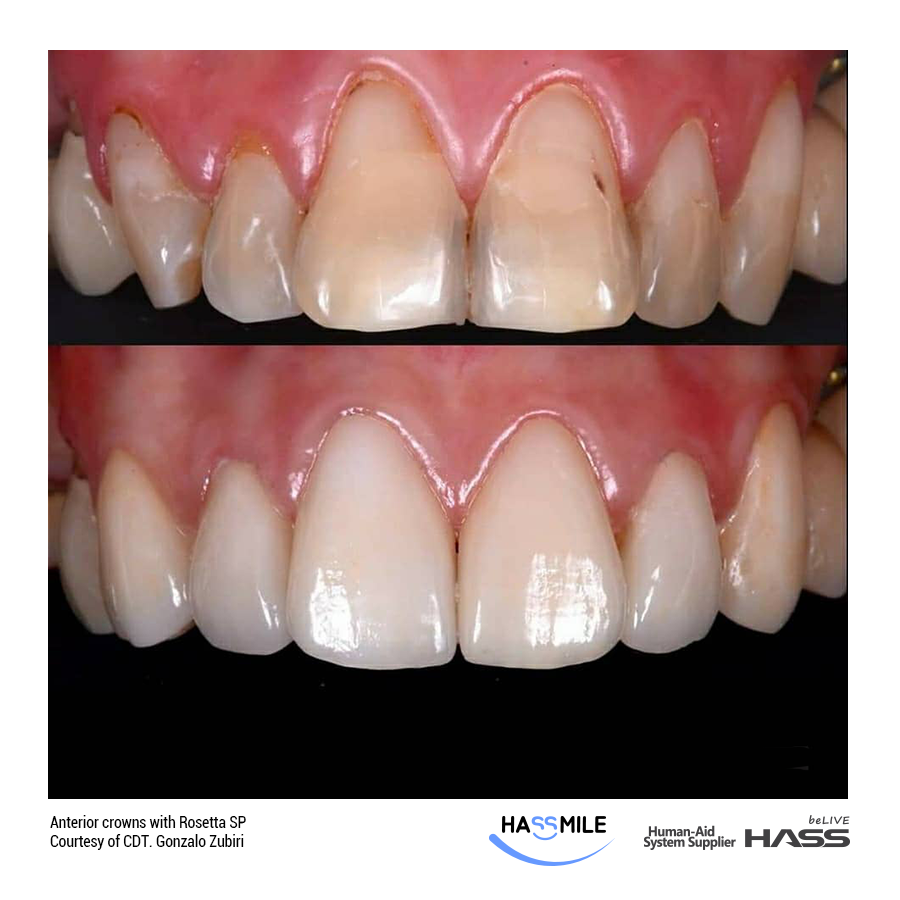 Anterior crowns with Rosetta SP