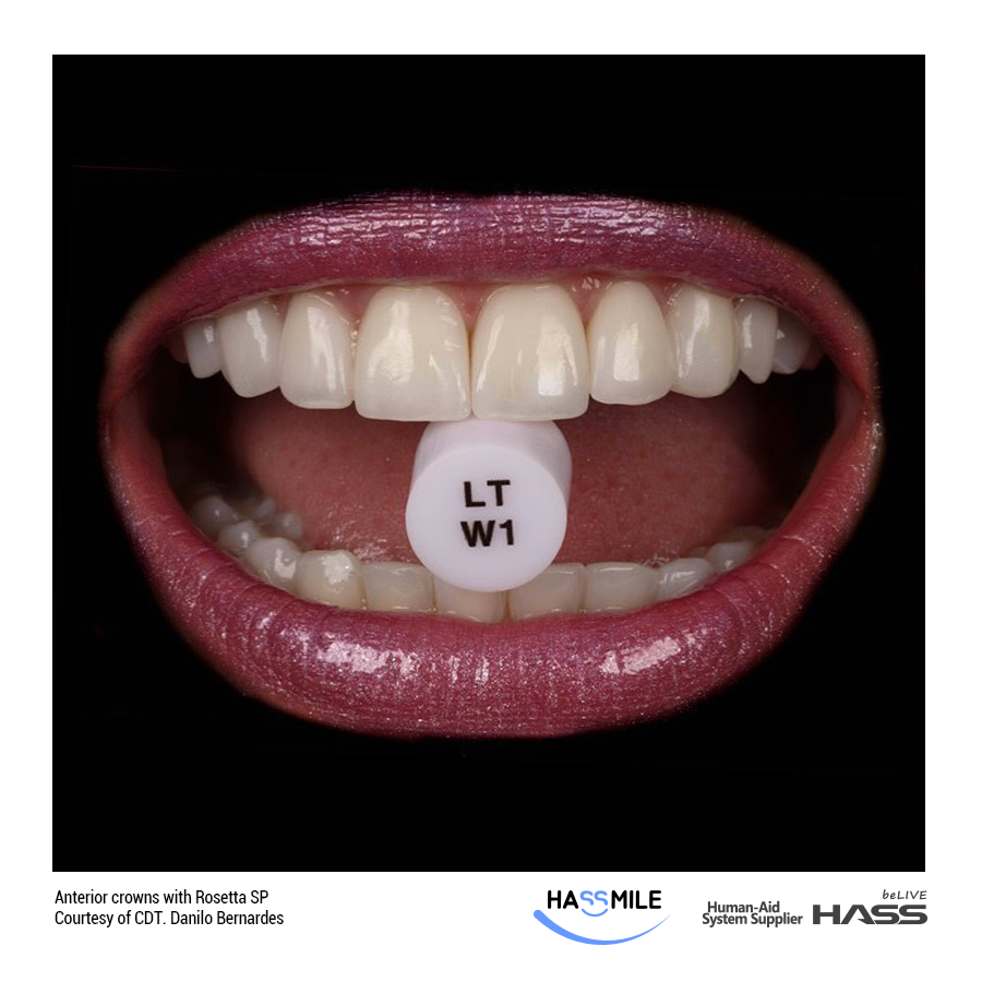 Anterior crowns with Rosetta SP (LT)