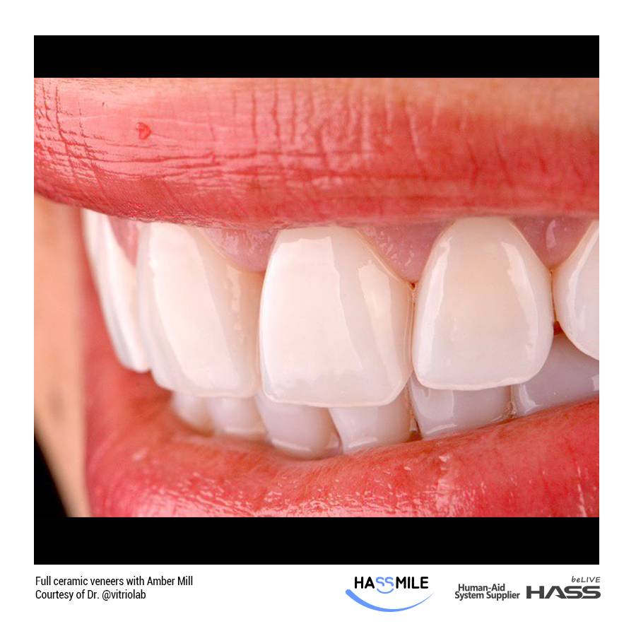 Full ceramic veneers with Amber Mill (MT)