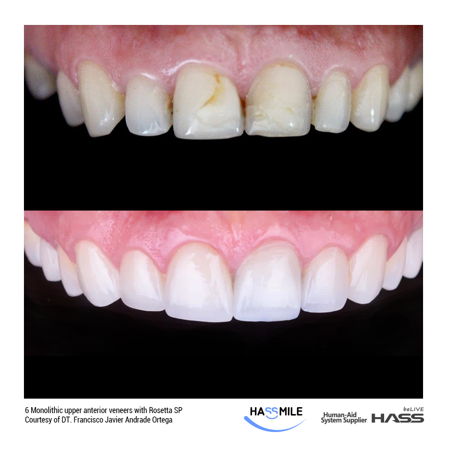 6 Monolithic upper anterior veneers with Rosetta SP (LT) + Staining technique (A1)