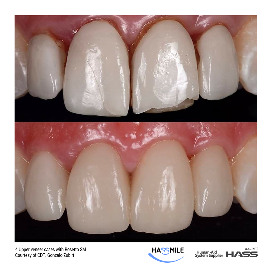 4 Upper veneer cases with Rosetta SM (LT) A2