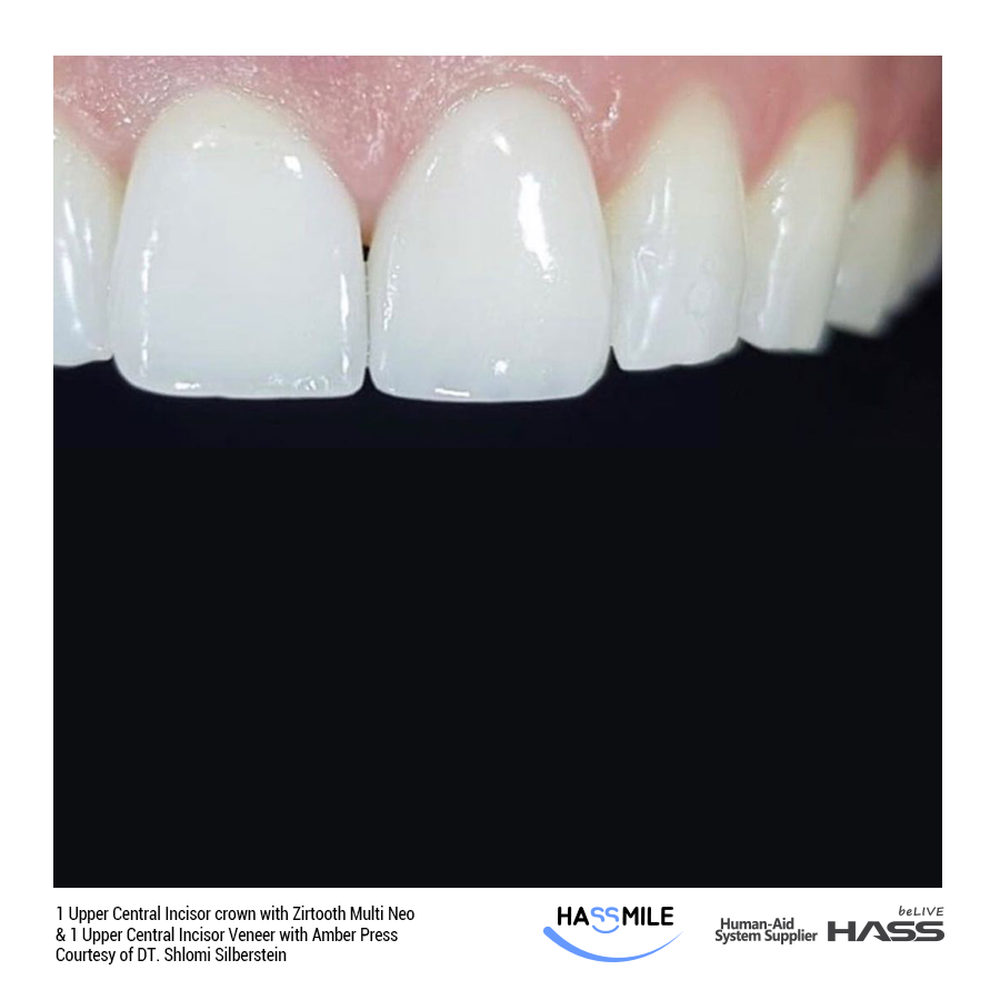 1 Upper Central Incisor crown with Zirtooth Multi Neo A1 & 1 Upper Central Incisor Veneer with Amber Press (LT) W1