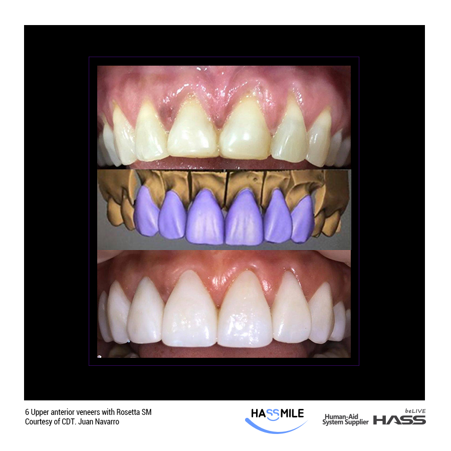 6 Upper anterior veneers with Rosetta SM (LT) W1