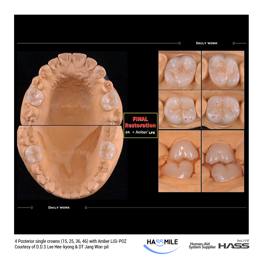 4 Posterior single crowns (15, 25, 36, 46) with Amber LiSi-POZ