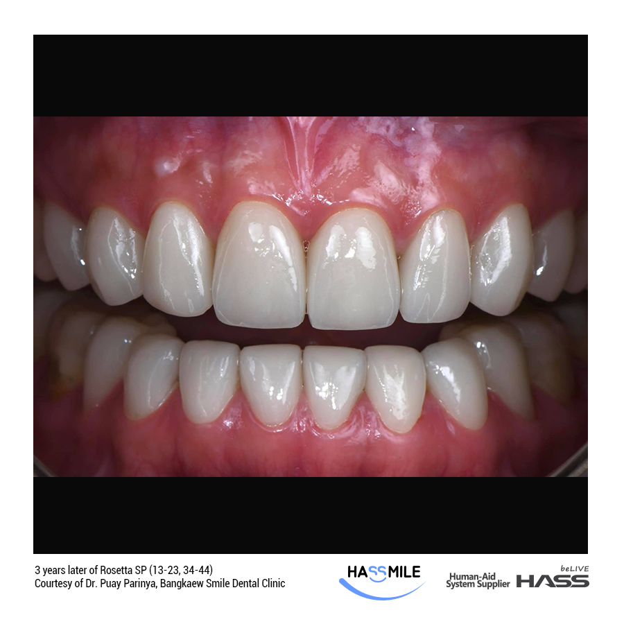 12 Anterior Veneer cases with Rosetta SP (LT)