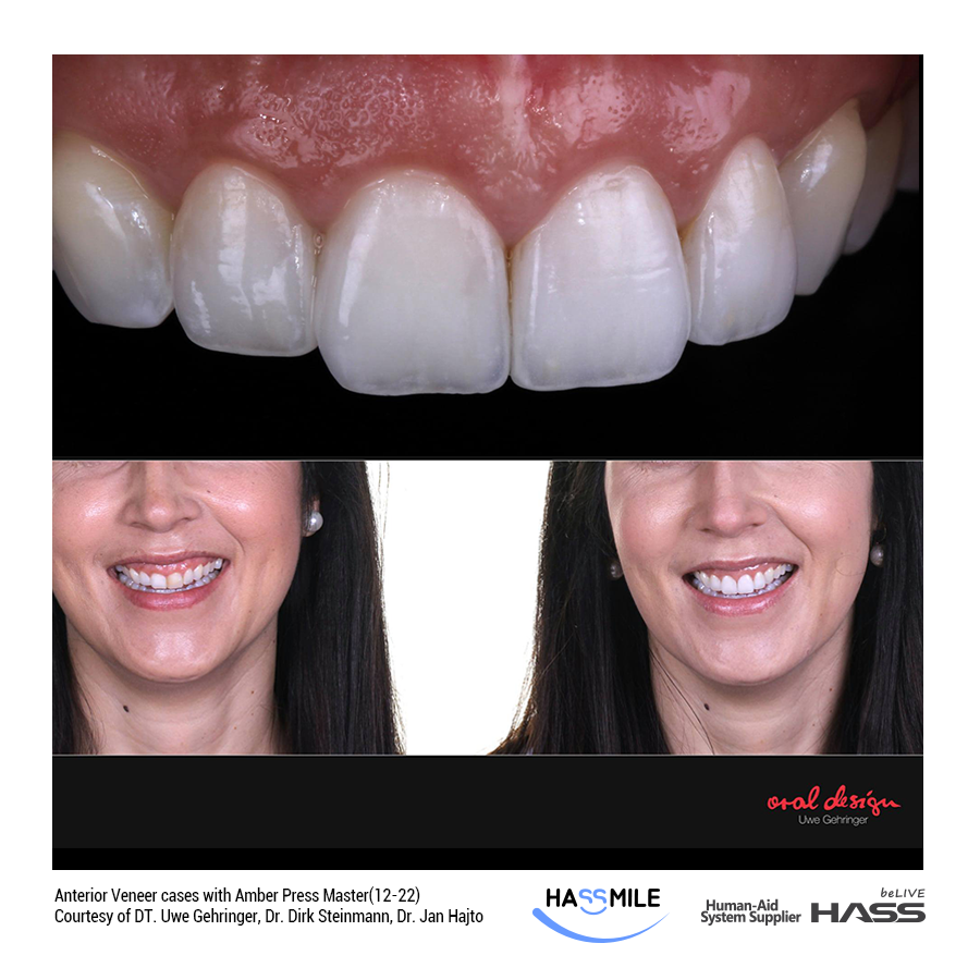 Anterior Veneer cases with Amber Press Master(12-22)