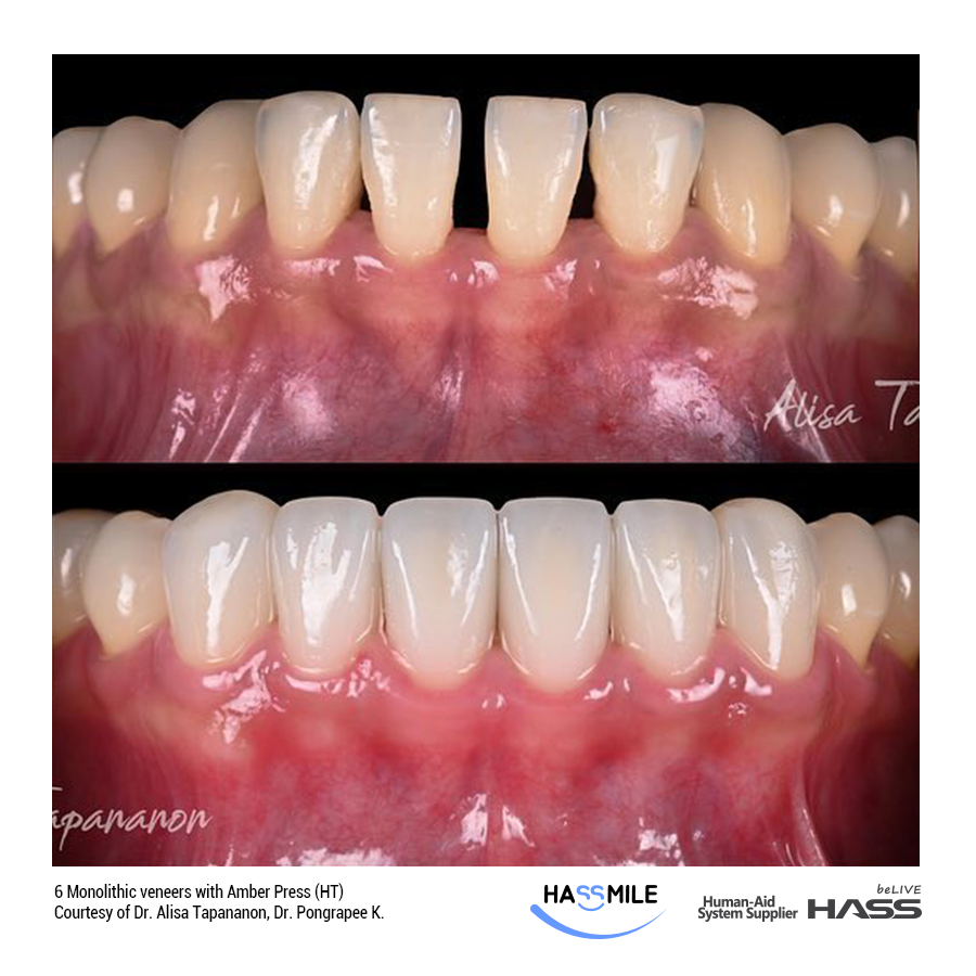 6 Monolithic veneers with Amber Press (HT)