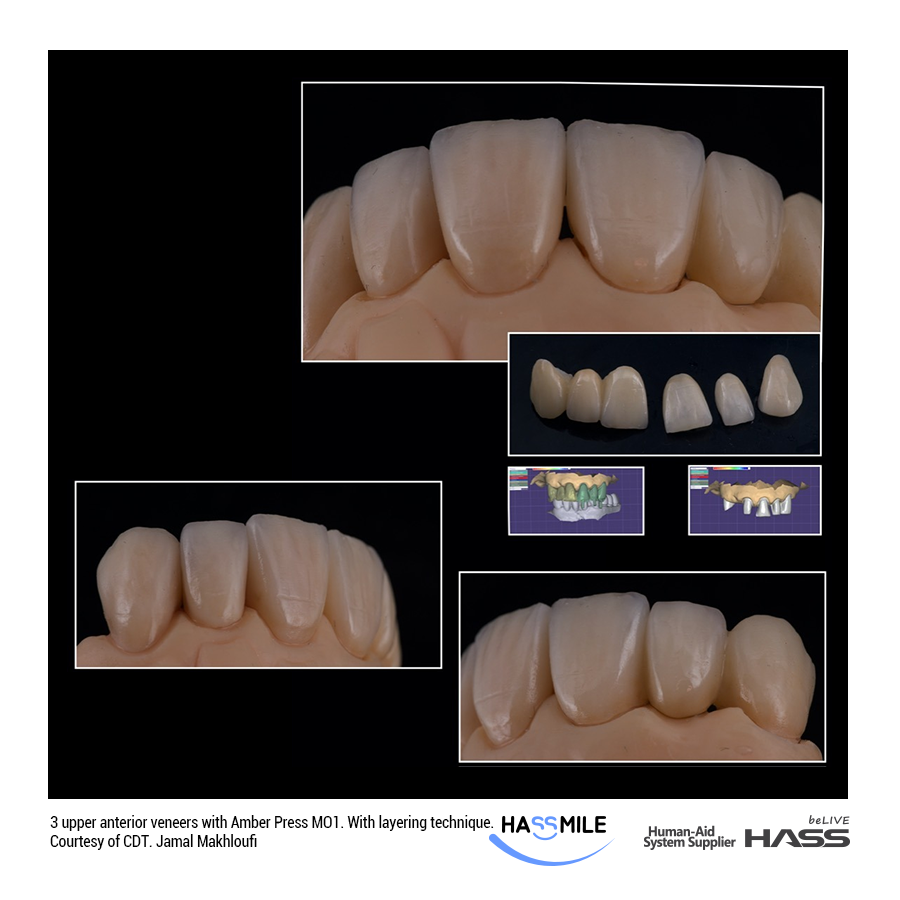 3 upper anterior veneers with Amber Press MO1. With layering technique