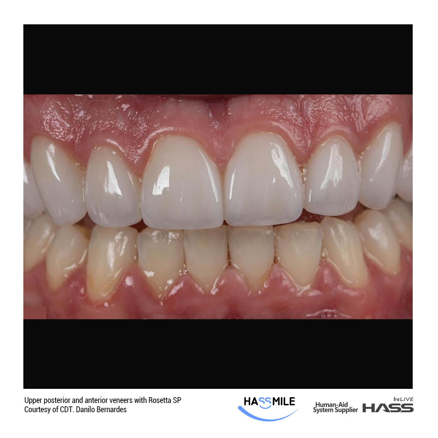 Upper posterior and anterior veneers with Rosetta SP