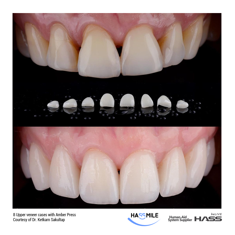 8 Upper veneer cases with Amber Press