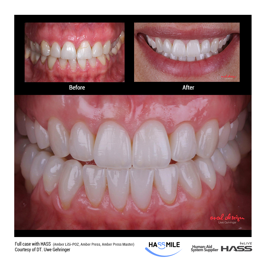 Full case with HASS ✔️Amber LiSi-POZ (HT/W4) for Posteriors ✔️Amber Press (LT/W3) for lower Anteriors ✔️Amber Press Master (MT/W0.5) for upper Anteriors