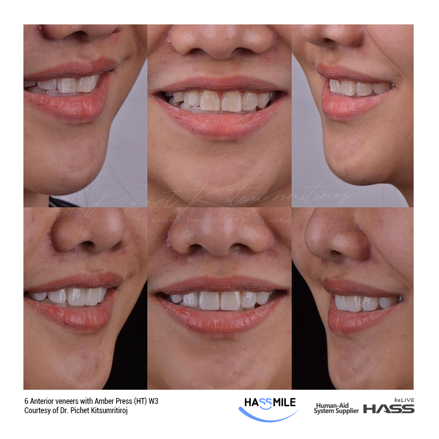 6 Anterior veneers with Amber Press (HT) W3