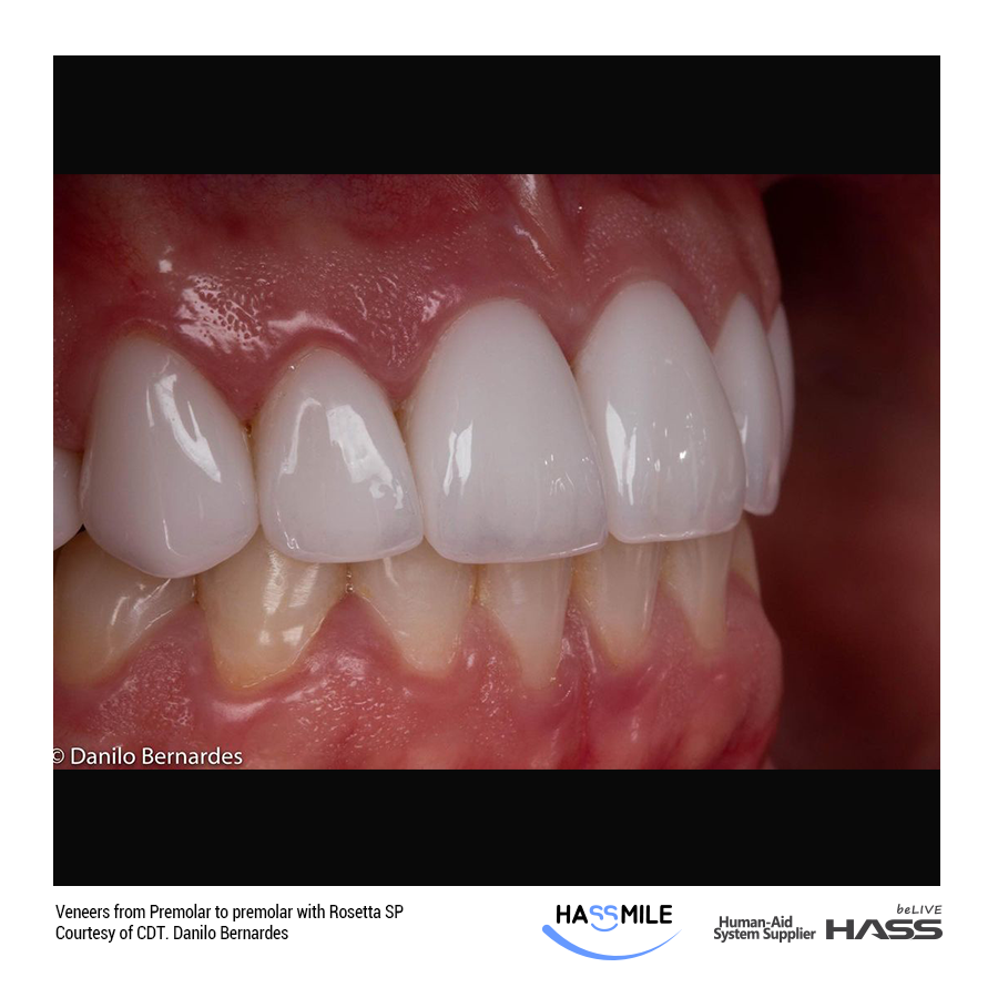 Upper Veneer cases with Rosetta SP