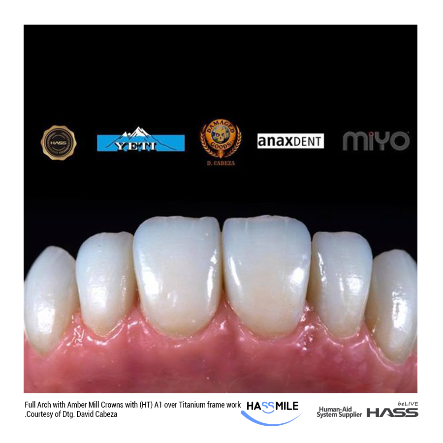 Full Arch with Amber Mill Crowns with (HT) / A1 over Titanium framework