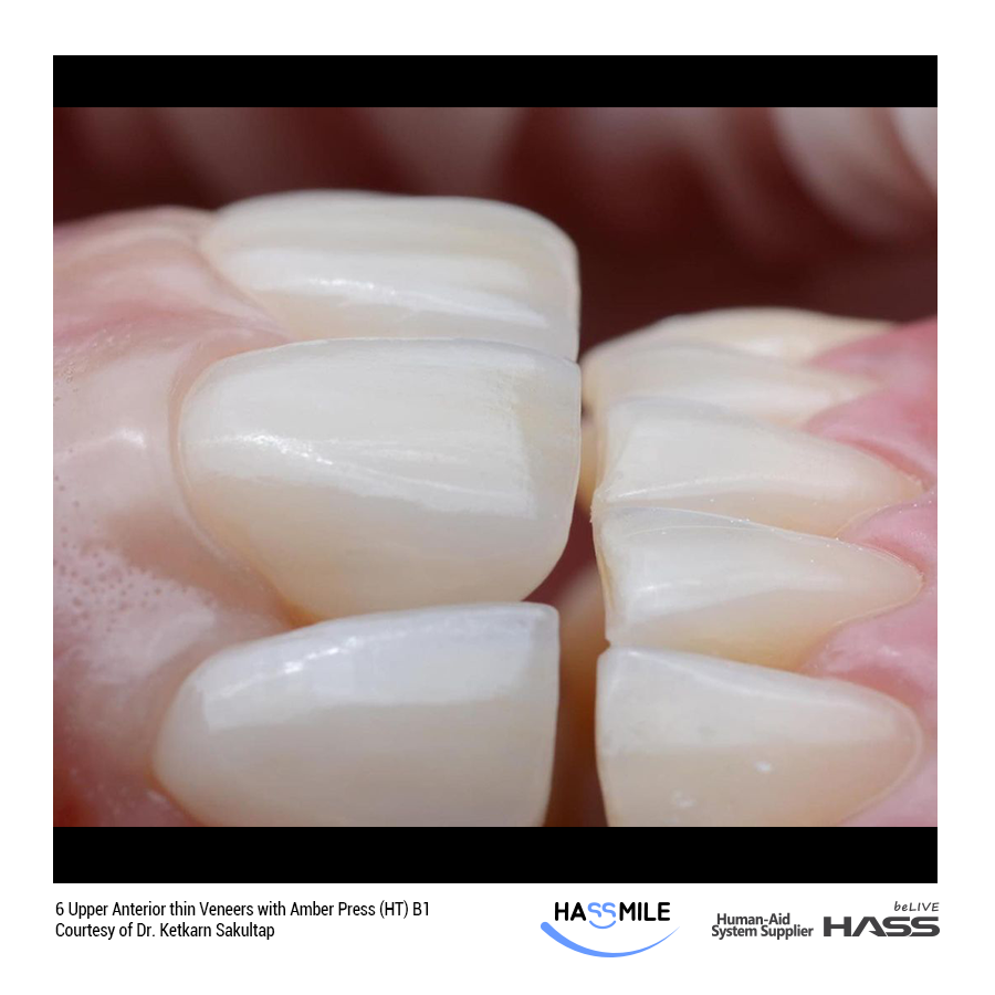 6 Upper Anterior thin Veneers with Amber Press (HT) B1