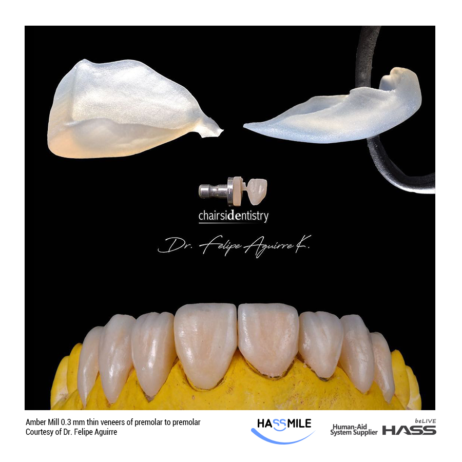 Amber Mill 0.3 mm thin veneers of premolar to premolar