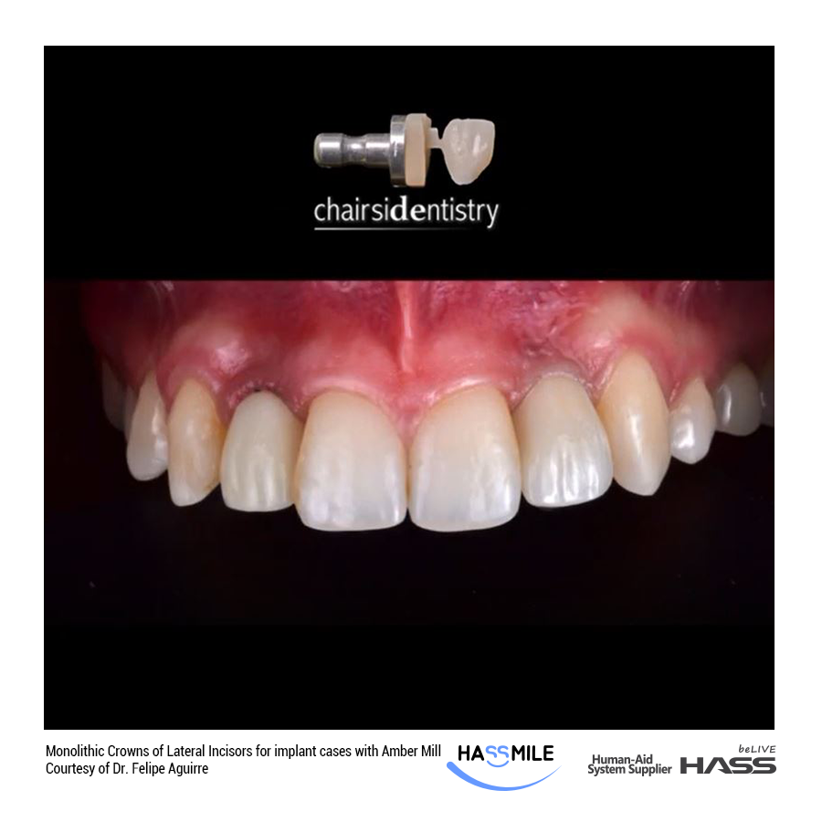 Monolithic Crowns of Lateral Incisors for implant cases with Amber Mill