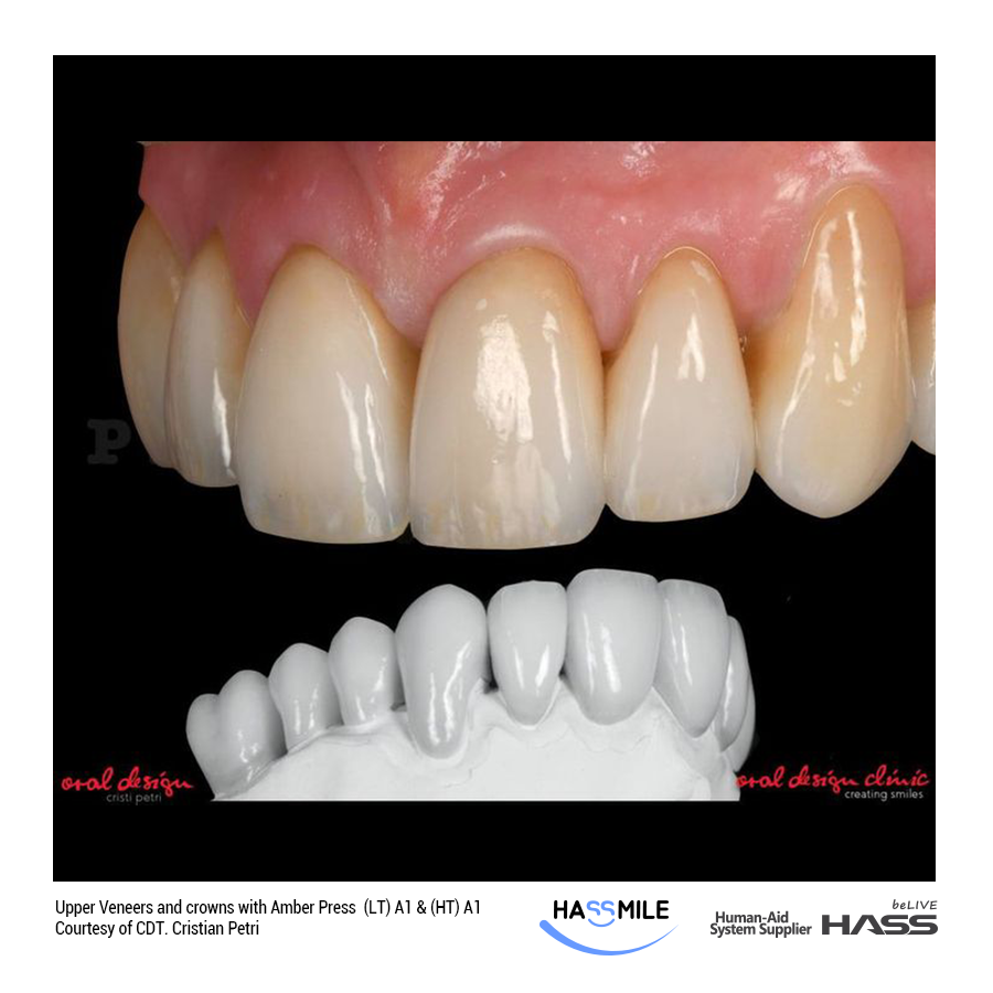 Upper Veneers and crowns with Amber Press  (LT) A1 & (HT) A1