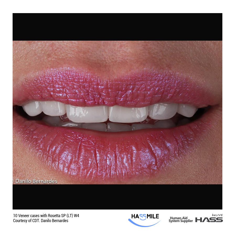 10 Veneer cases with Rosetta SP (LT) W4