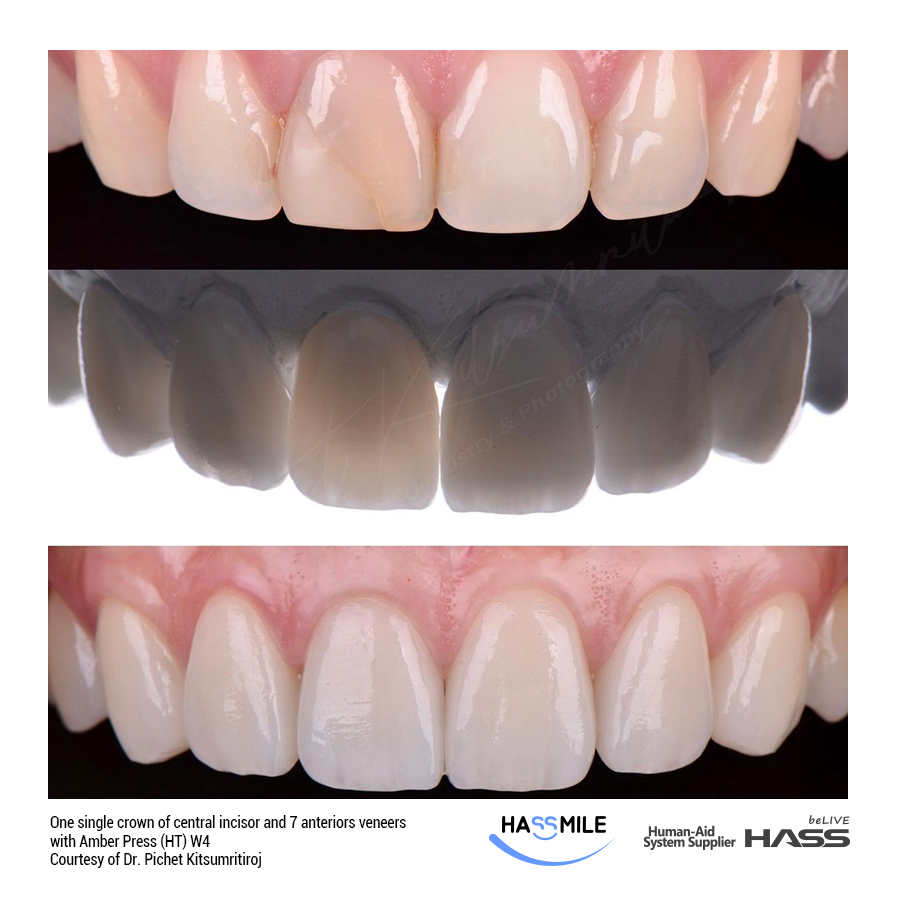 One single crown of central incisor and 7 anteriors veneers with Amber Press (HT) W4