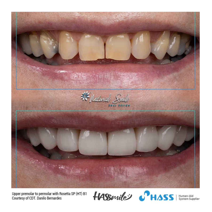 Upper premolar to permolar with Rosetta SP (HT) B1