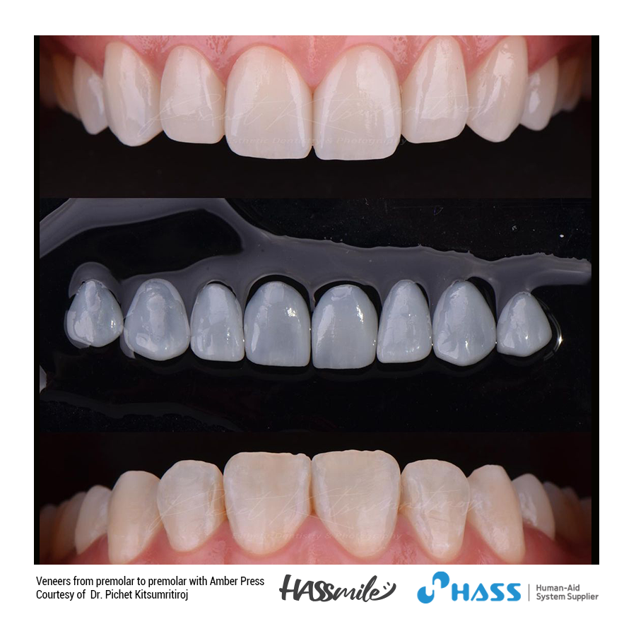 Veneers from premolar to premolar with Amber Press (HT) W4