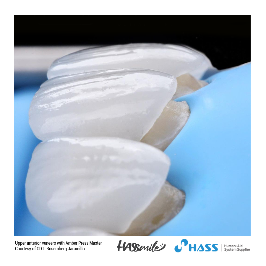 Upper anterior veneers with Amber Press Master (HT) A0.5