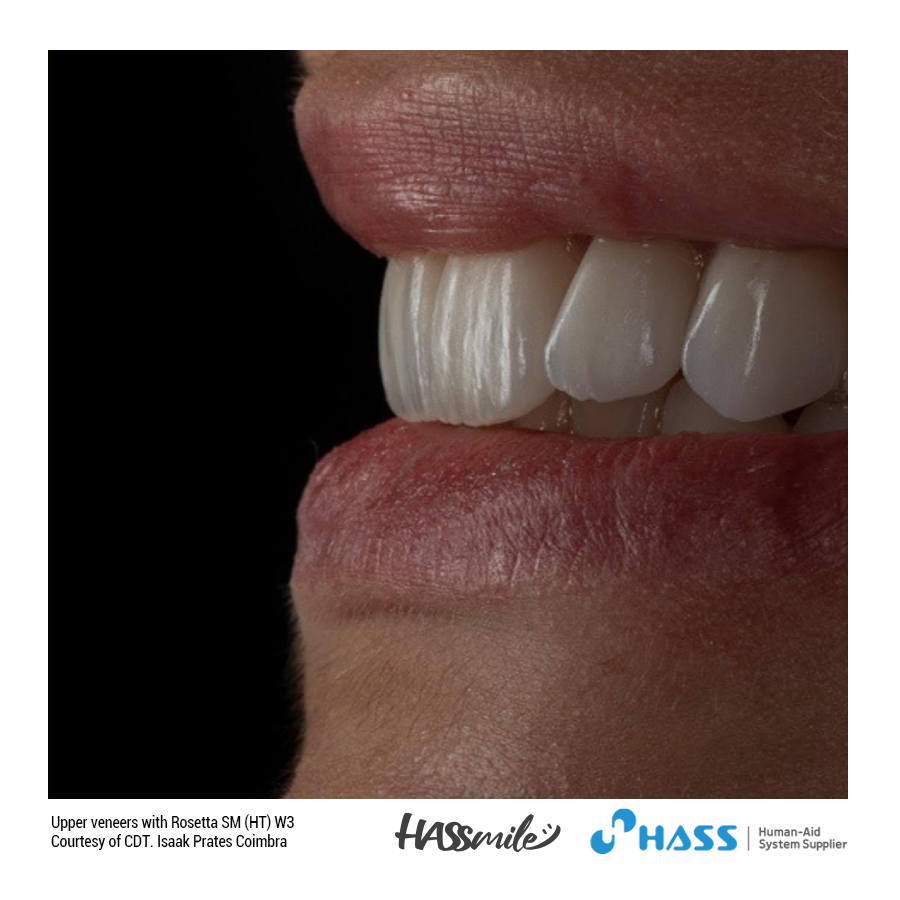 Upper veneers with Rosetta SM (HT) W3