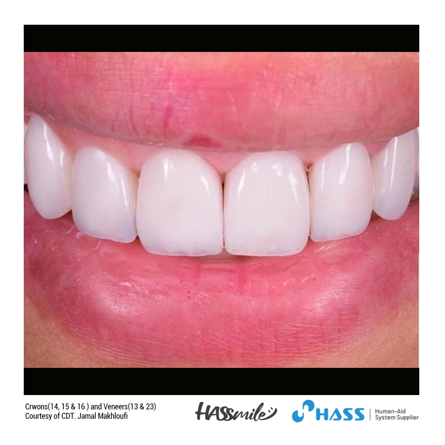 Crwons(14, 15 & 16) and Veneers(13 & 23) with Amber Press (MO) 0