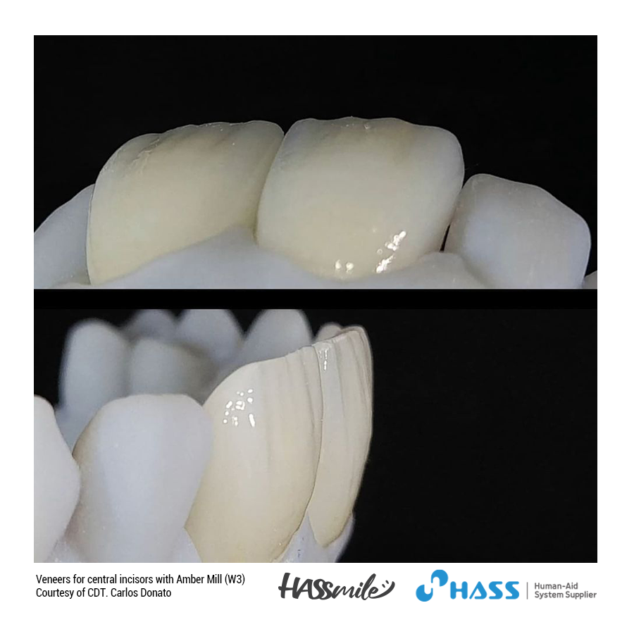 Veneers for central incisors with Amber Mill (W3)