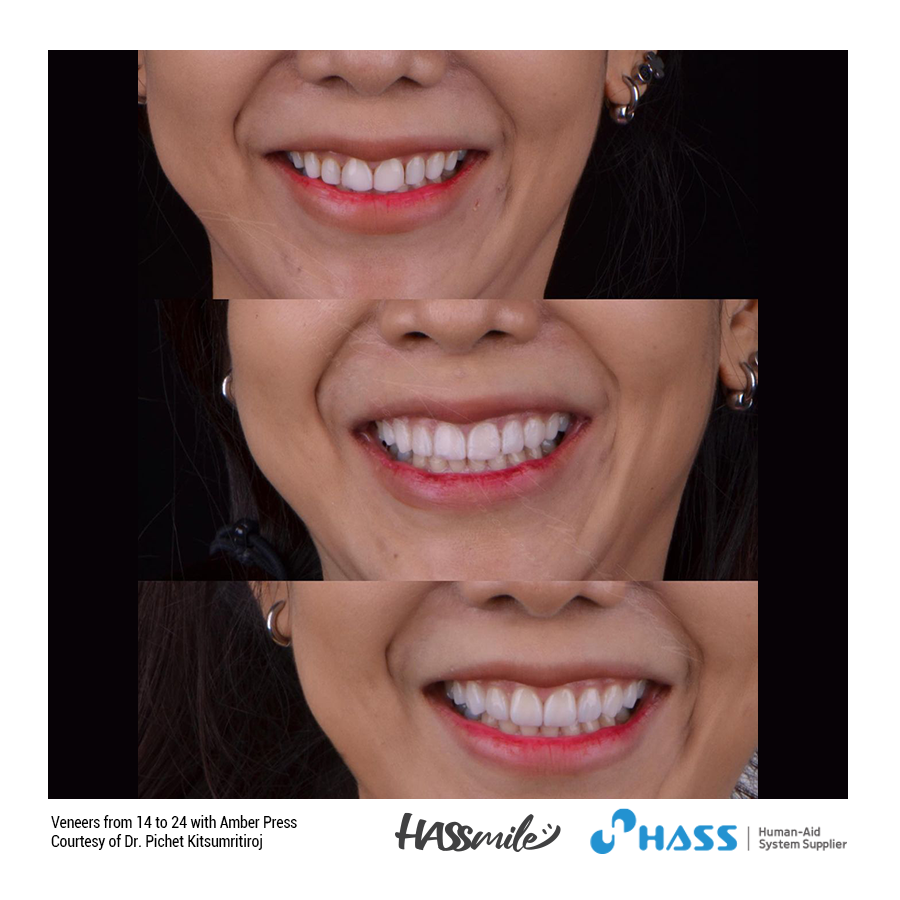 Veneers from 14 to 24 with Amber Press (HT) W2
