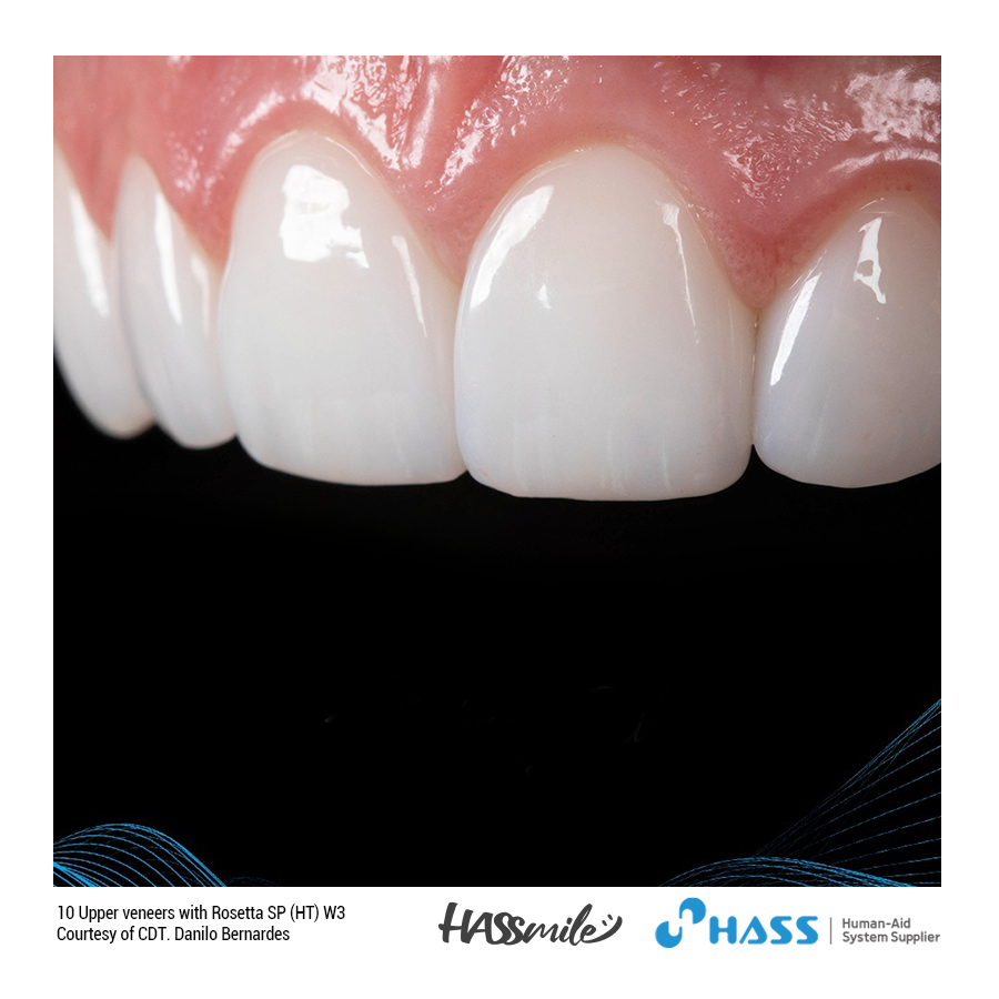 10 Upper veneers with Rosetta SP (HT) W3