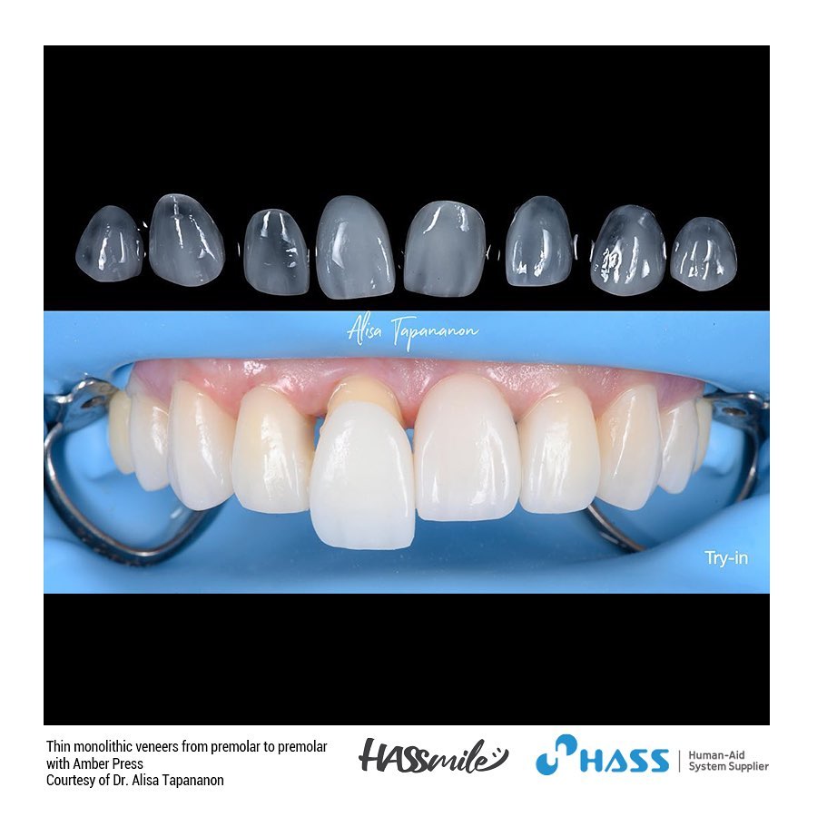 Thin monolithic veneers from premolar to premolar with Amber Press