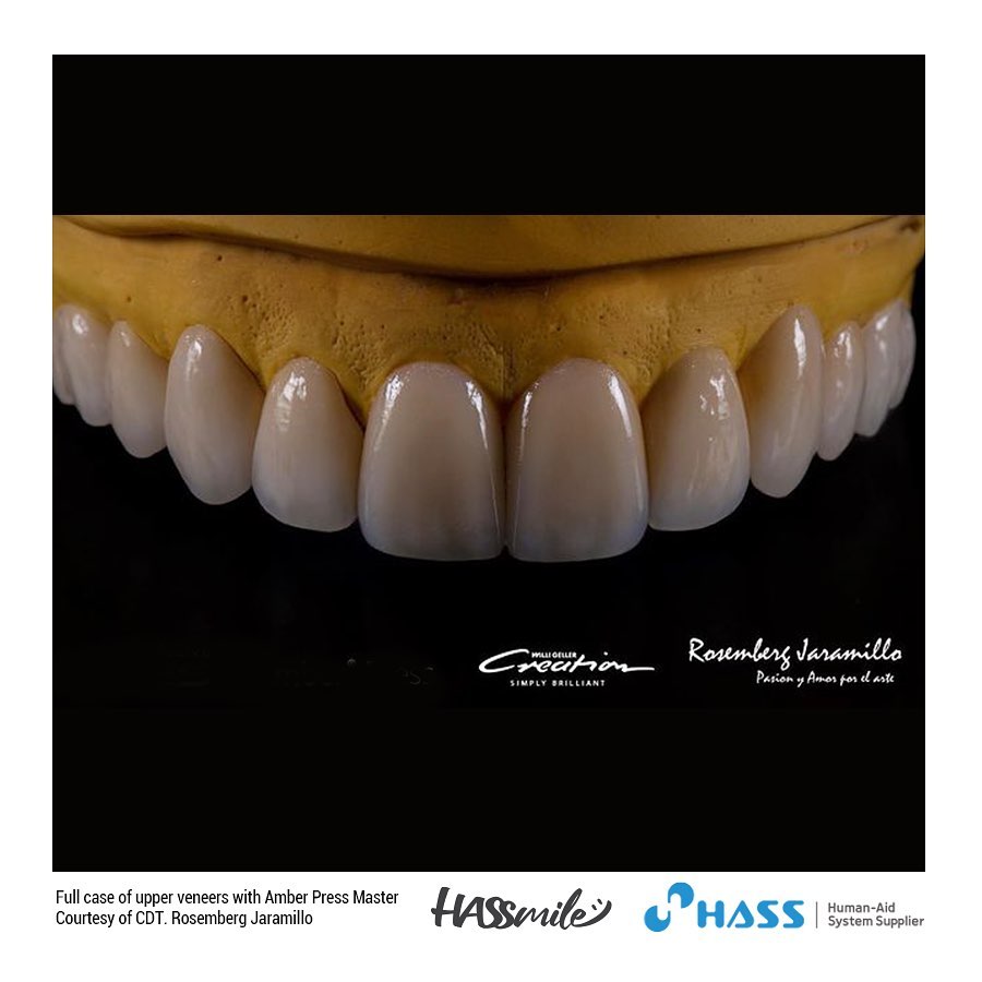 Full case of upper veneers with Amber Press Master HT+ A0.5 shade